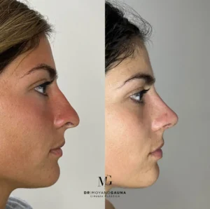 rinoplastia precio