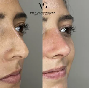 rinoplastia precio