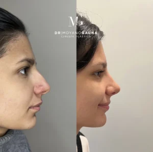 rinoplastia precio