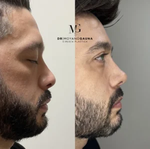 rinoplastia precio