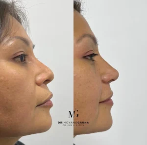 rinoplastia precio