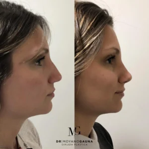 rinoplastia precio