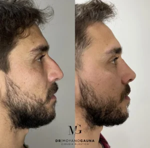 rinoplastia precio