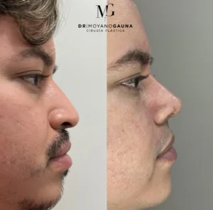 rinoplastia precio