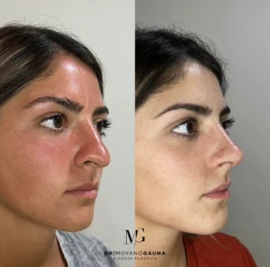 rinoplastia precio